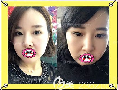 全切雙眼皮修復(fù)術(shù)后1個(gè)月效果圖 全切雙眼皮修復(fù)術(shù)后1個(gè)月效果圖