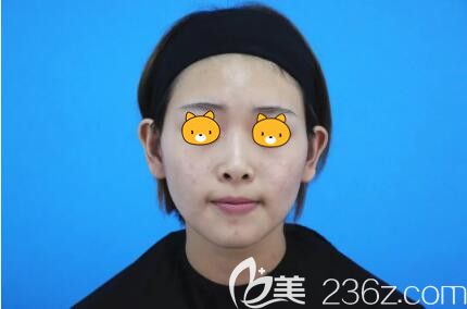 注射英諾術(shù)后<span style= 注射英諾術(shù)后<span style=