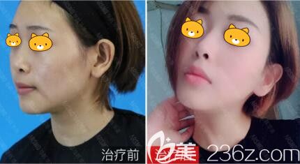 注射英諾術(shù)前術(shù)后對(duì)比 注射英諾術(shù)前術(shù)后對(duì)比