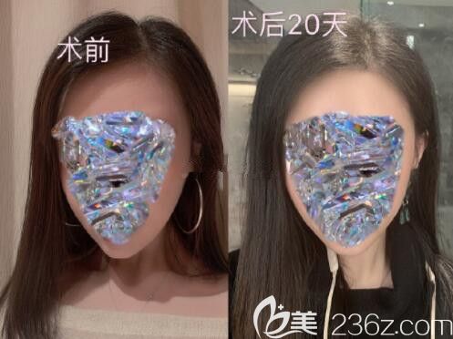 韓國(guó)芭堂Batang額頭縮小案例 韓國(guó)芭堂Batang額頭縮小案例