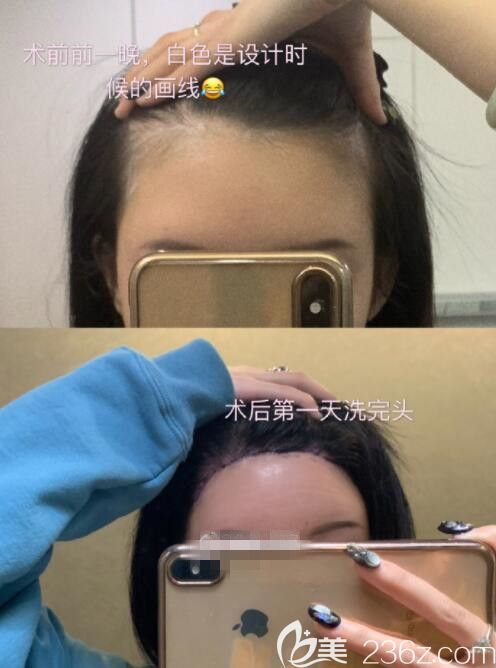 面診了芭堂整形外科后選擇韓國芭堂Batang旻長煥做了額頭縮小和提升