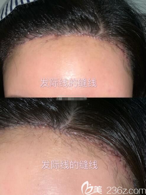 旻長(zhǎng)煥做額頭縮小怎么樣 旻長(zhǎng)煥做額頭縮小怎么樣