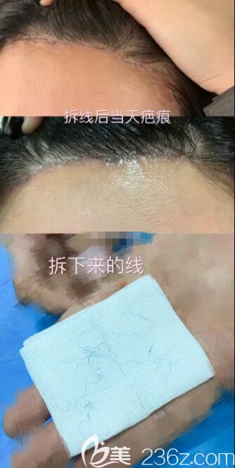 韓國(guó)芭堂Batang額頭提升 韓國(guó)芭堂Batang額頭提升