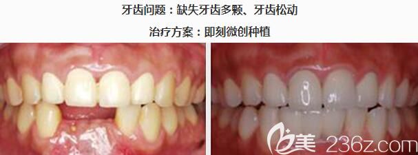 青島維樂口腔徐文磊院長種植牙案例 青島維樂口腔徐文磊院長種植牙案例