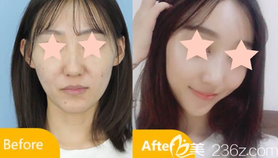 長(zhǎng)春中妍整形馬速里主任鼻綜合案例效果圖 長(zhǎng)春中妍整形馬速里主任鼻綜合案例效果圖