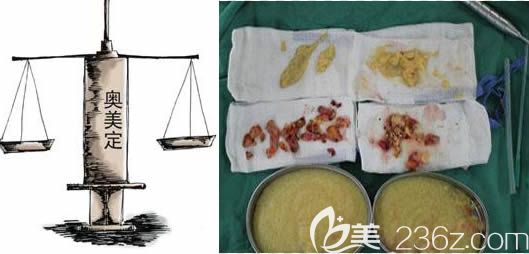 長(zhǎng)春中妍整形取出奧美定注射物內(nèi)容