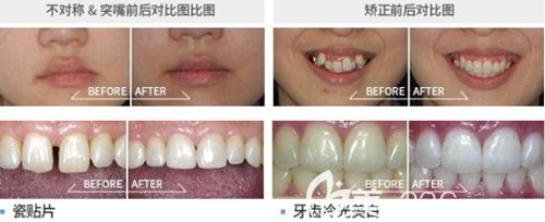 韓國(guó)首爾椰美牙科醫(yī)院美牙案例