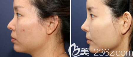 西安鼻修復(fù)案例