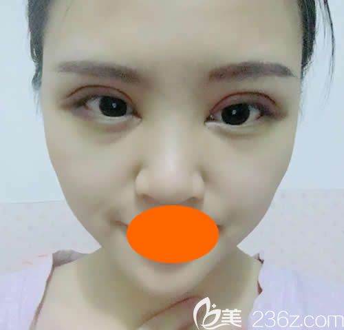 眼睛一大一小的我找贛州華美牛先翠做全切雙眼皮術(shù)后第7天效果