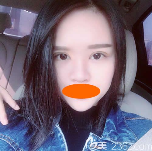 眼睛一大一小的我找贛州華美牛先翠做全切雙眼皮術(shù)后第20天效果