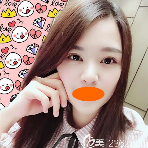 眼睛一大一小的我找贛州華美牛先翠做全切雙眼皮術(shù)后第32天效果