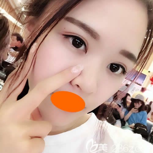 來看眼睛一大一小的我找贛州華美牛先翠做全切雙眼皮效果好不好