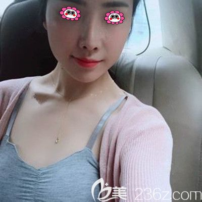 假體豐胸前的樣子 假體豐胸前的樣子