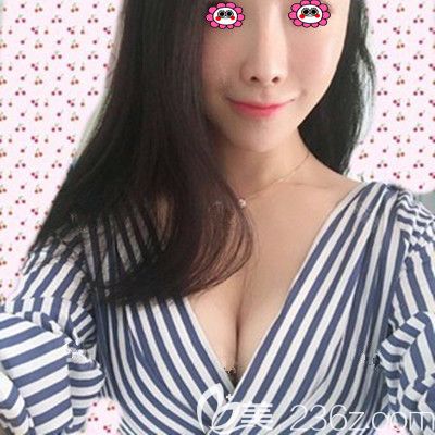 有胸就是任性，在衡陽美萊做完250cc的曼托假體豐胸后改變的不止是size…