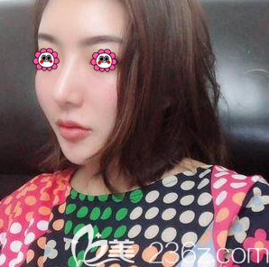 在北京美萊做超皮秒祛斑第13天效果 在北京美萊做超皮秒祛斑第13天效果