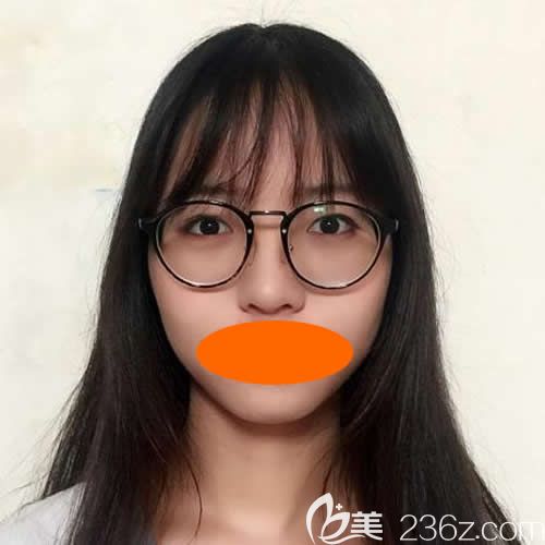 上饒尚美整形劉育鳳給我做新月型雙眼皮前照片 上饒尚美整形劉育鳳給我做新月型雙眼皮前照片