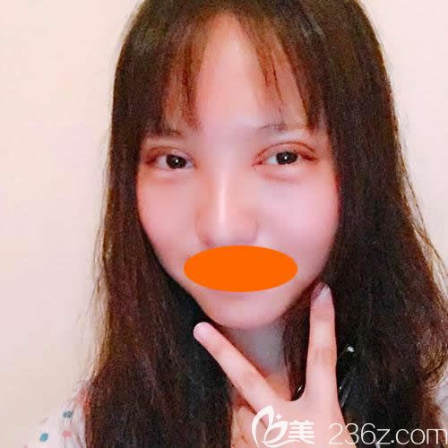 上饒尚美整形劉育鳳給我做新月型雙眼皮術(shù)后第3天效果 上饒尚美整形劉育鳳給我做新月型雙眼皮術(shù)后第3天效果