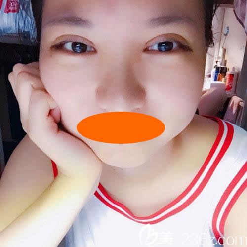 上饒尚美整形劉育鳳給我做新月型雙眼皮術(shù)后第7天效果圖 上饒尚美整形劉育鳳給我做新月型雙眼皮術(shù)后第7天效果圖