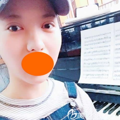 找上饒尚美劉育鳳做新月型雙眼皮術(shù)后第14天效果 找上饒尚美劉育鳳做新月型雙眼皮術(shù)后第14天效果