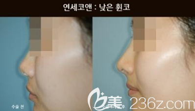 韓國Yonsei C＆ENT隆鼻手術(shù)案例