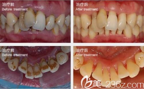 廈門登特口腔<!--<i data=20240703-sp></i>-->穎醫(yī)生牙周病治療前后對(duì)比圖 廈門登特口腔<!--<i data=20240703-sp></i>-->穎醫(yī)生牙周病治療前后對(duì)比圖