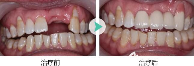 青島維樂口腔張奎醫(yī)生即刻種植牙案例 青島維樂口腔張奎醫(yī)生即刻種植牙案例