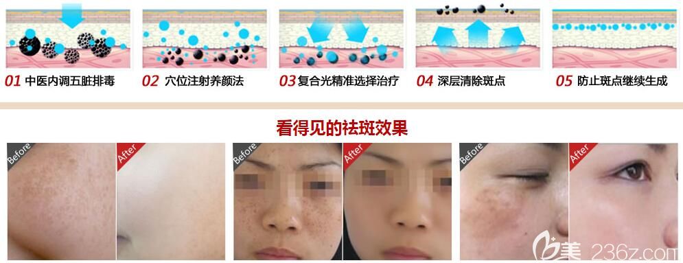 趙堅鋼院長祛斑技術(shù)及案例效果 趙堅鋼院長祛斑技術(shù)及案例效果