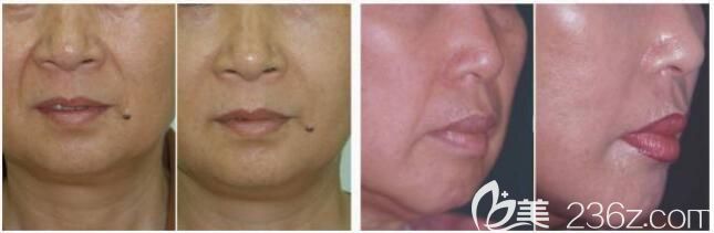 趙堅鋼除皺案例對比照 趙堅鋼除皺案例對比照