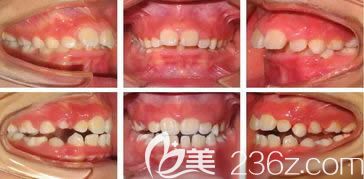 廈門登特口腔陳歡喜醫(yī)生兒童早期牙齒矯正效果圖 廈門登特口腔陳歡喜醫(yī)生兒童早期牙齒矯正效果圖
