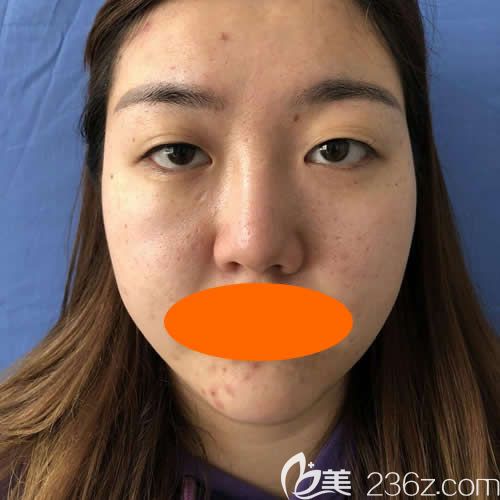 景德鎮(zhèn)圣嘉麗院長劉志強做眼綜合+鼻綜合術(shù)前照片 景德鎮(zhèn)圣嘉麗院長劉志強做眼綜合+鼻綜合術(shù)前照片