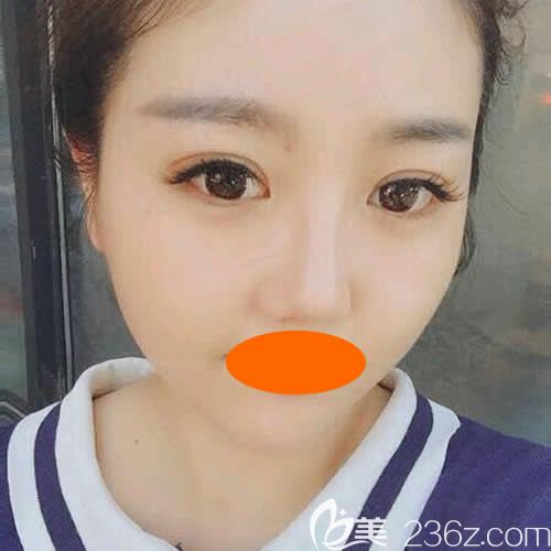 找景德鎮(zhèn)圣嘉麗院長劉志強做眼綜合+鼻綜合術(shù)后第36天效果 找景德鎮(zhèn)圣嘉麗院長劉志強做眼綜合+鼻綜合術(shù)后第36天效果