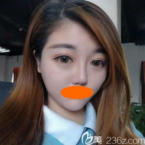 說說我找景德鎮(zhèn)圣嘉麗院長劉志強做眼綜合+鼻綜合的真實感受