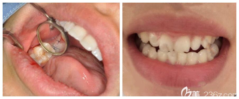 青島維樂口腔梁騰醫(yī)生單顆種植牙案例