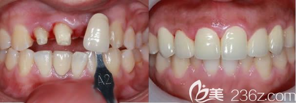廈門登特口腔候紅醫(yī)生美容冠案例效果對(duì)比圖
