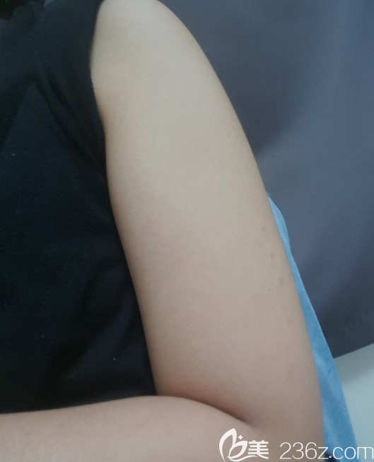 術(shù)前胳膊 術(shù)前胳膊