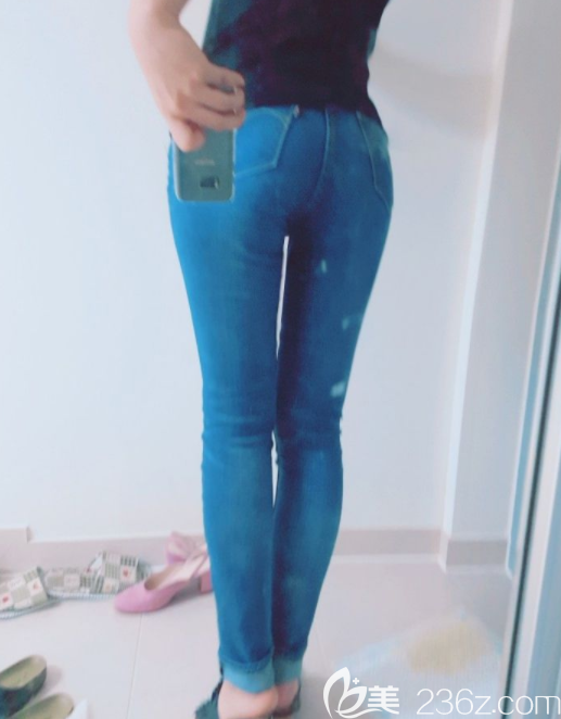 維摩整形外科姜在九吸脂案例 維摩整形外科姜在九吸脂案例