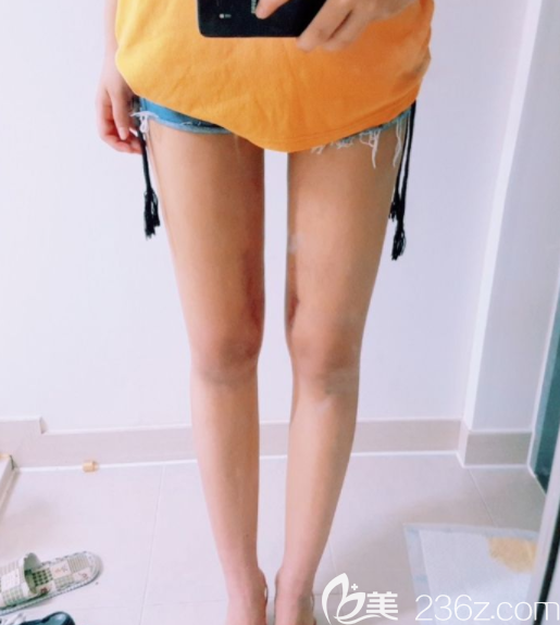 姜在九做吸脂好嗎 姜在九做吸脂好嗎