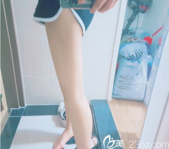 吸脂術(shù)后三個(gè)月 吸脂術(shù)后三個(gè)月