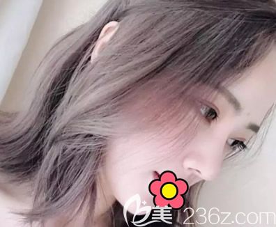 找呼和浩特張高貴整形醫(yī)院王成毅割雙眼皮1個(gè)月后 又做了假體隆鼻+自體耳軟骨隆鼻手術(shù)