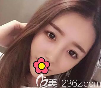 自體脂肪面部填充會(huì)凹陷嗎 呼和浩特張高貴整形王成毅真人全臉脂肪填充案例告訴您