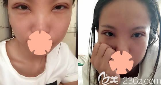 在長春奧拉克整形做雙眼皮+開眼角術(shù)后4天照