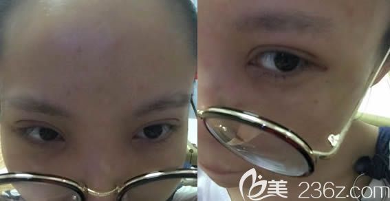 在長春奧拉克做雙眼皮+開眼角術(shù)后7天照
