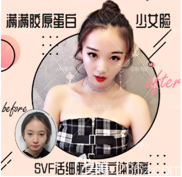 北京京韓喬愛軍SVF活細(xì)胞多維立體面雕案例 北京京韓喬愛軍SVF活細(xì)胞多維立體面雕案例