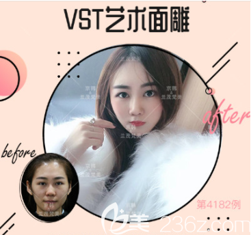 北京京韓喬愛軍醫(yī)生VST藝術(shù)面雕案例 北京京韓喬愛軍醫(yī)生VST藝術(shù)面雕案例