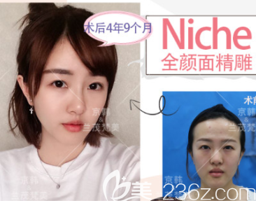 北京京韓喬愛軍醫(yī)生NIC抗衰老面雕案例 北京京韓喬愛軍醫(yī)生NIC抗衰老面雕案例