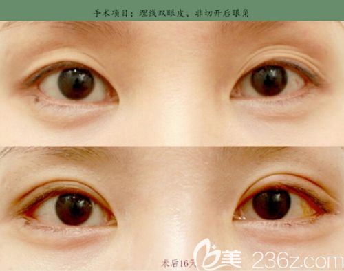 韓國美line埋線雙眼皮+開后眼角案例