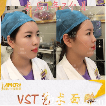 北京京韓喬愛生VST藝術(shù)脂肪面雕案例