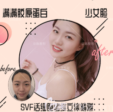 北京京韓喬愛生SVF活細胞多維立體面部脂肪精雕案例