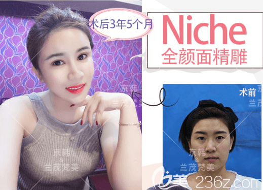 北京京韓喬愛生NIC抗衰老面部脂肪精雕案例