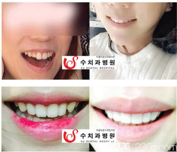 韓國SU牙科醫(yī)院瓷貼面<span style= 韓國SU牙科醫(yī)院瓷貼面<span style=